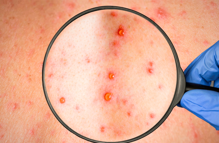 Alejandro Moreno exige el regreso del cubrebocas ante brote de sarampión: “Es negligencia de Morena”